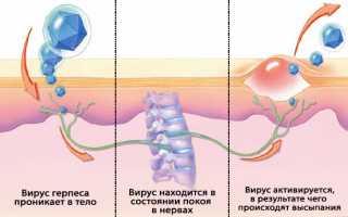 Симптомы и лечение герпеса на губах